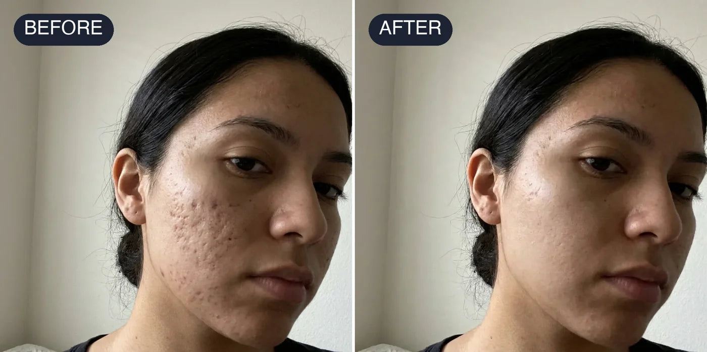 Before and after: the look of acne marks visibly lighter